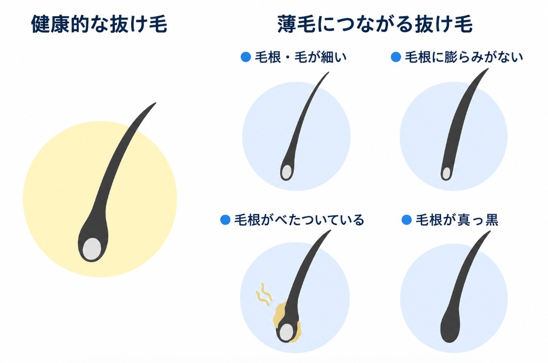 健康的な抜け毛と薄毛につながる抜け毛の毛根の違い