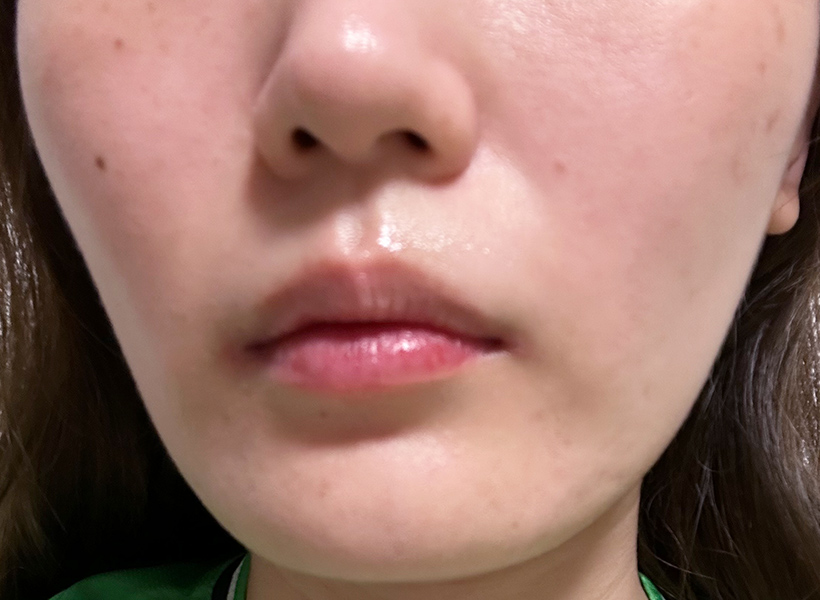 Aさん治療開始後の皮膚画像