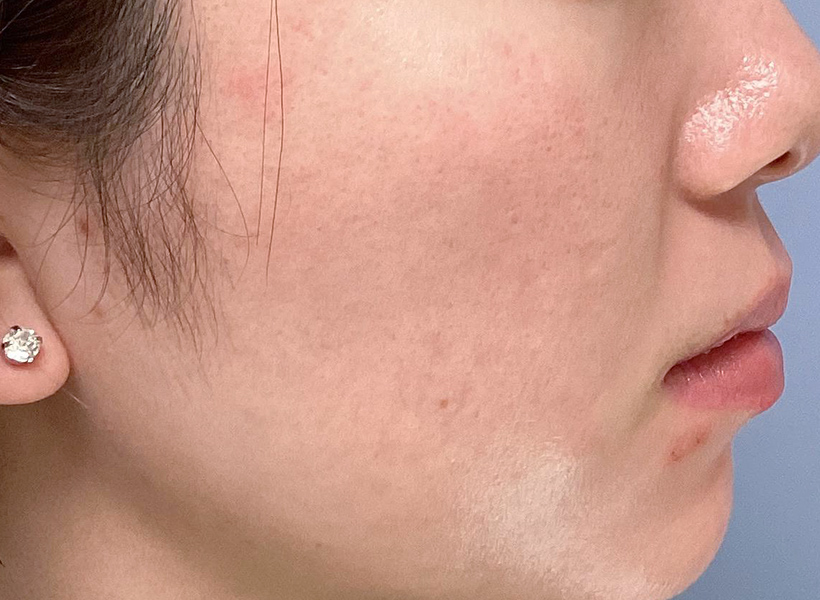 Dさん治療開始後の皮膚画像